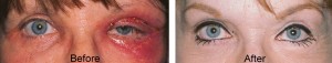 eye lift surgery complications eye lift surgery complication