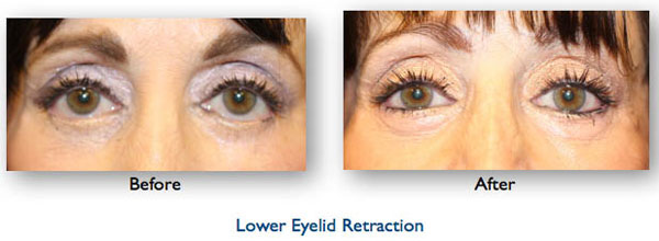 blepharoplasty complication resulting in lower eyelid retraction repaired by Dr Amiya Prasad