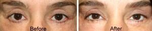 lower eyelid retraction and ectropion lower eyelid retraction and ectropion after eyelid surgery
