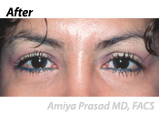 lower-eyelid-surgery-after-1