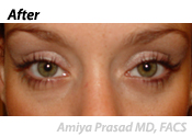lower-eyelid-surgery-after-2