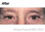 lower-eyelid-surgery-after-photo