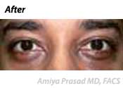 lower-eyelid-surgery-after