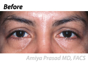 lower-eyelid-surgery-before-1