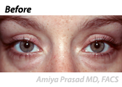 lower-eyelid-surgery-before-2