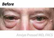 lower-eyelid-surgery-before-photo