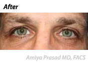 male-blepharoplasty-after-2
