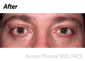 male-lower-eyelid-surgery-after
