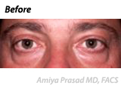 male-lower-eyelid-surgery-before