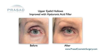 droopy eyelid upper eyelid filler before and after Garden City Long Island