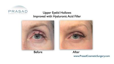 upper eyelid filler injection before and after New York City