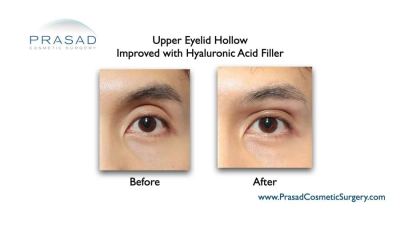 fillers to upper lid before and after NYC