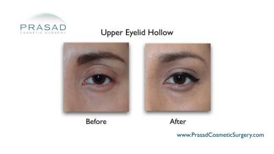filler upper eyelid before and after Manhattan NYC