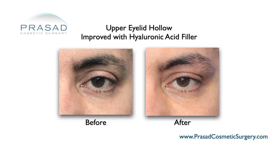 Upper Eyelid Filler Before and After Photos | New York