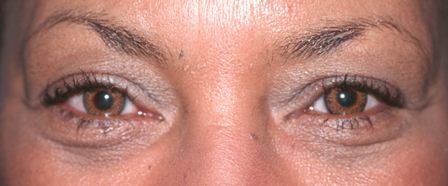 after transconjunctival blepharoplasty results female patient