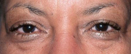 before eyelid surgery dark skin female