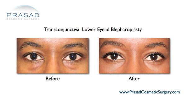 african-american lower eyelid surgery
