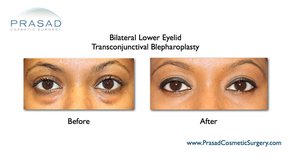 before and after lower eyelid surgery