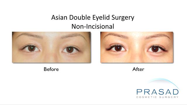 Asian Double Eyelid Surgery