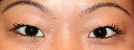 Female asian double eyelid surgery before
