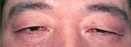 Before Double Eyelid Surgery male