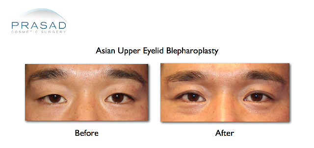 Asian eyelid surgery before and after