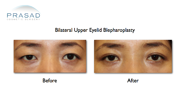 Asian eyelid surgery upper eyelid blepharoplasty before and after