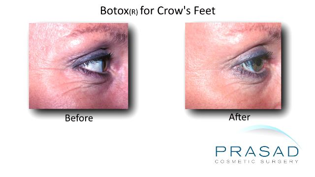 Botox before and after crow's feet (non-surgical eye lift procedure)