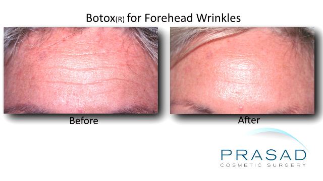 before and after Botox cosmetic treatment for forehead wrinkles in Garden City, New York
