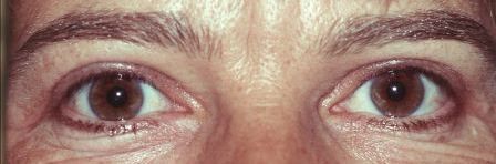 after eyelid blepharoplasty surgery