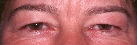 before eye lift surgery (blepharoplasty) female patient