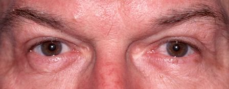 after eye lift surgery male patient