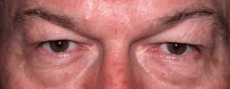 male patient with hooded eyes before eyelid blepharoplasty 