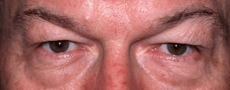 before male eye lift surgery