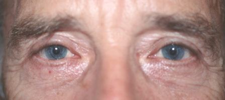 eye lift portfolio: after male blepharoplasty