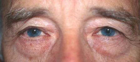 eye lift portfolio: before male blepharoplasty 