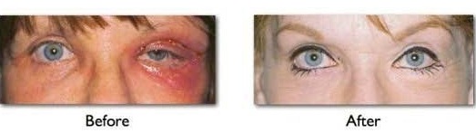 before and after eye lift revision surgery performed by Dr. Amiya Prasad on female patient