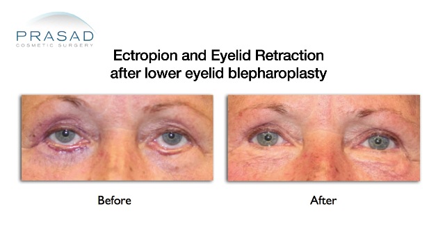 Lower Eyelid Retraction and Ectropion