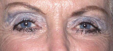 after eye bag surgery female