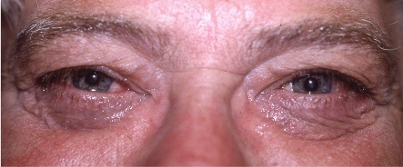 after eye bag surgery -male blepharoplasty