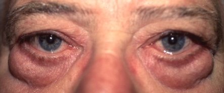 before male eye bag surgery or male blepharoplasty