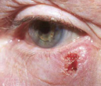 eyelid skin cancer