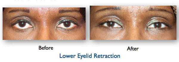 patient with lower eyelid retraction, corrective eyelid surgery performed by Dr. Amiya Prasad, before and after results