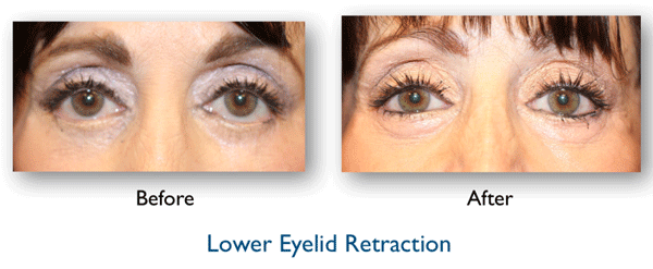 Eyelid retraction before and after corrective eyelid surgery by Dr. Amiya Prasad