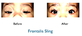 ptosis in children before and after ptosis surgery