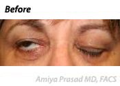 Facial-Paralysis-treatment-before-photo-2