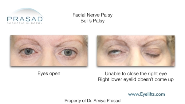 Facial nerve palsy causing eye exposure - actual patient Dr Amiya Prasad