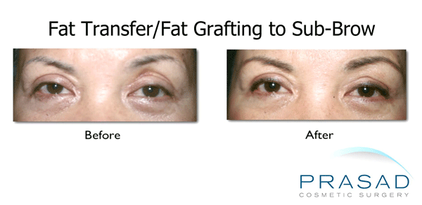 Fat transfer for upper eyelid hollowness before and after, older female patient