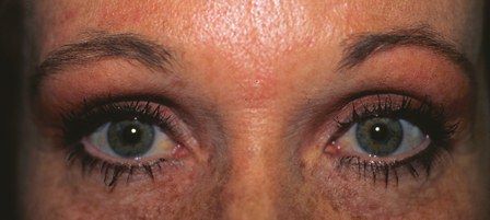 upper eye lift surgery post operation female patient