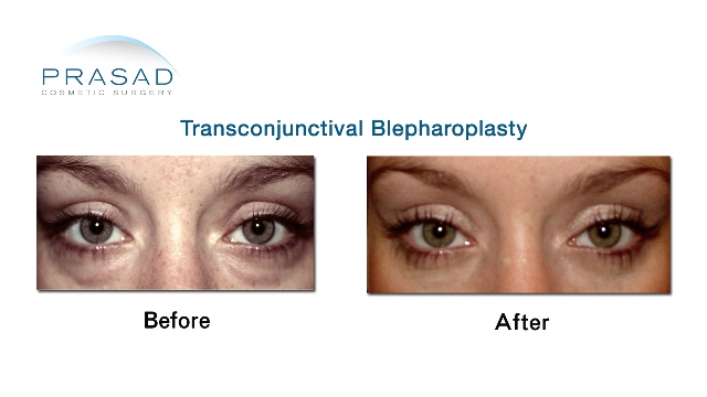Female Transconjunctival-Blepharoplasty Before and After
